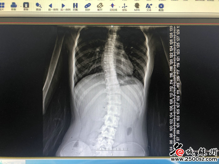 名城苏州：13岁女孩高低肩竟因这种病 调查显示孩子患病率可能高达10% (1).jpg