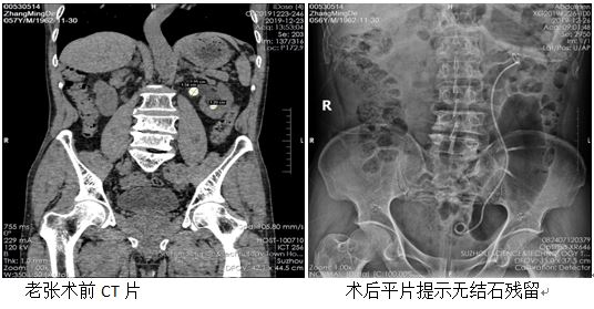 赞！局麻就能完成的肾结石手术.jpg