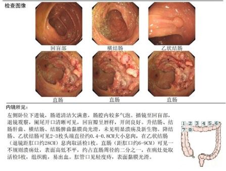 普外二科开展新辅助同步放化疗序贯手术治疗低位直肠癌.JPG