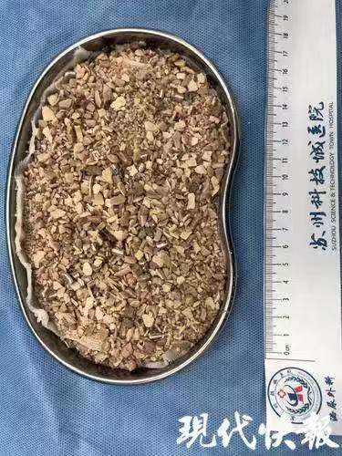 现代快报（ZAKER）：小伙膀胱内结石有小孩拳头大，多年前曾 ......-2.jpg