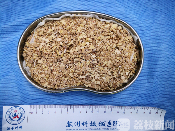 荔枝网：25岁小伙多年尿痛尿血，一查发现，膀胱内竟有颗“巨石”…… (3).jpg
