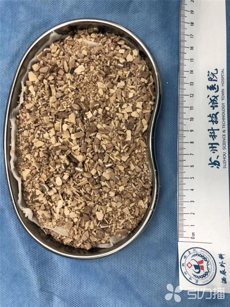 苏报集团（引力播）：塑料丝带塞进自己尿道 苏州小伙膀胱长出“巨石”-2.jpg
