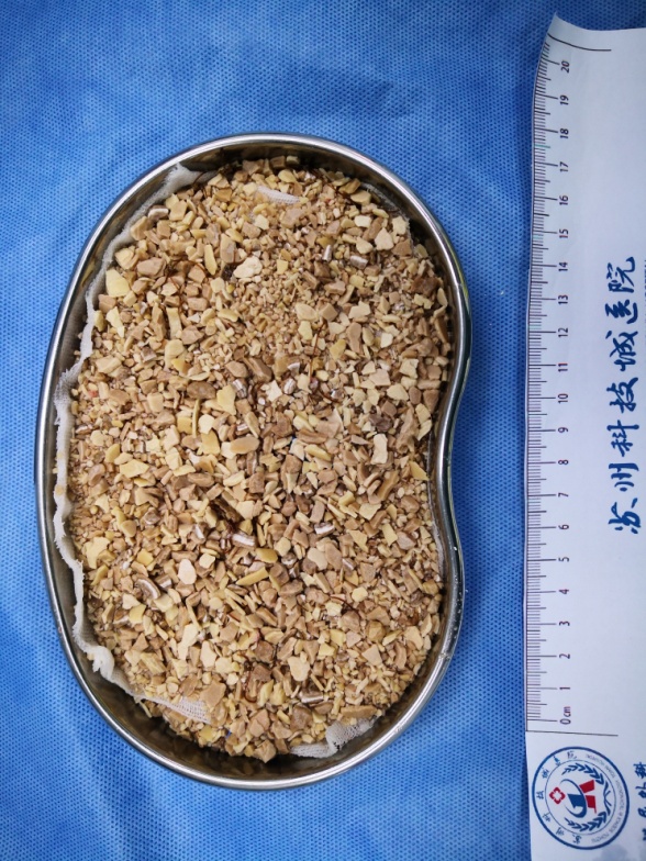 小伙膀胱内长出8cm巨大结石-2.jpg