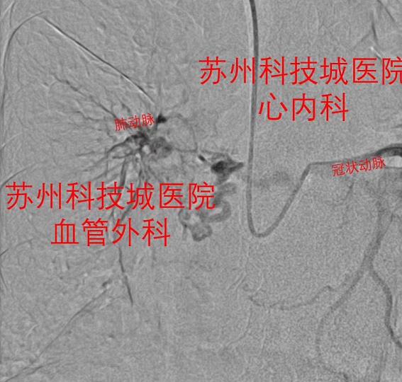 苏州阿姨急性心衰 藏了六十多年的毛病被揭开 (2).jpg