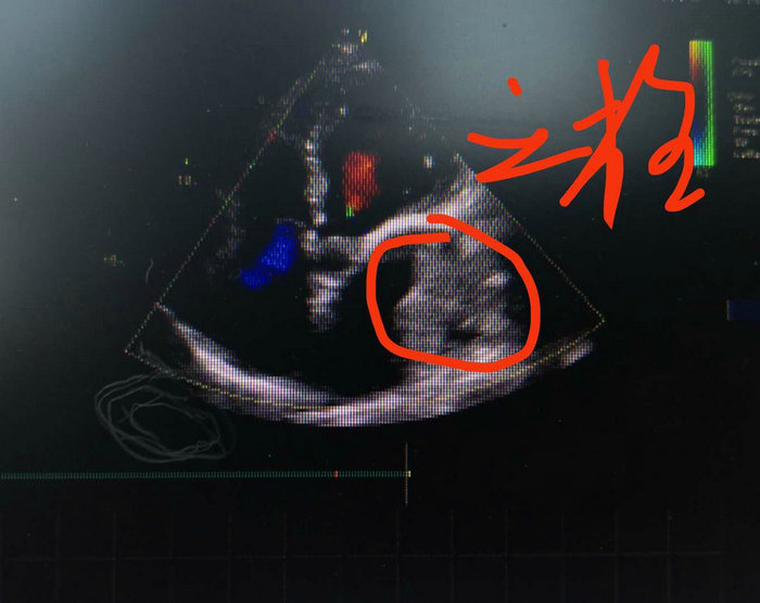男子擅自停药致心房大量血栓，心血管病人要警惕 (1).jpg