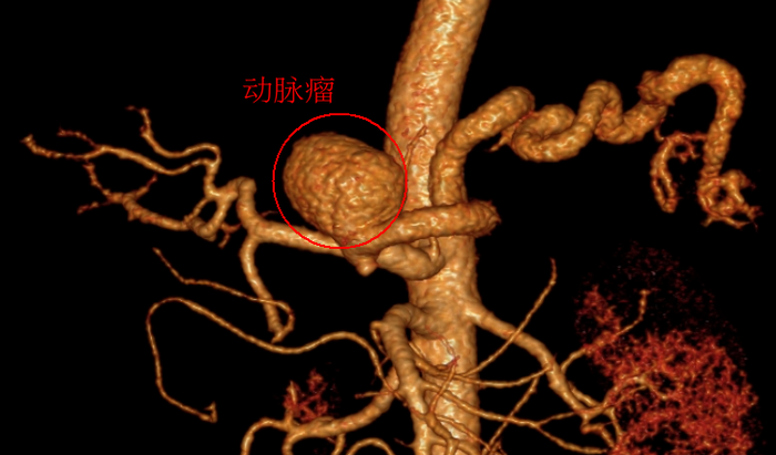 苏州男子肚子疼痛竟意外查出腹腔干动脉瘤.png