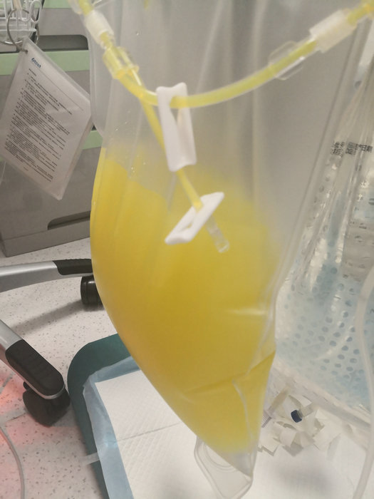 血脂超出正常16倍！年轻男子突发急性胰腺炎入院 (1).jpg