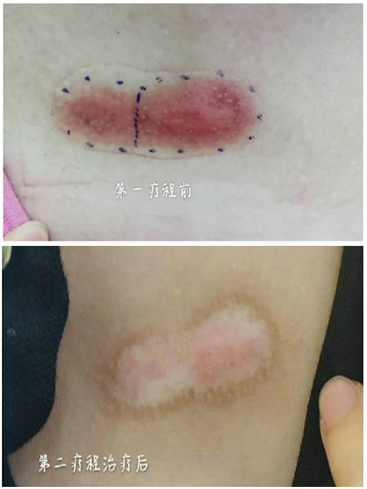 治疗顽固瘢痕 我院核医学科有妙招 (1).jpg