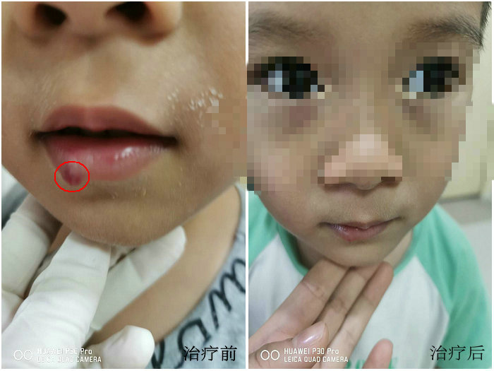 治疗顽固瘢痕 我院核医学科有妙招 (2)_副本.jpg
