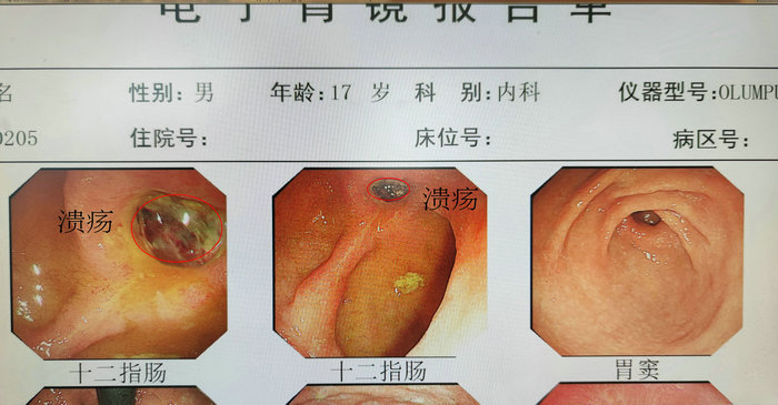 17岁小伙便血近1000毫升 医生提醒小心这种菌！ (2).jpeg