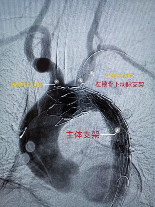 主动脉夹层！介入血管外科又完成一例高难度手术2.jpg
