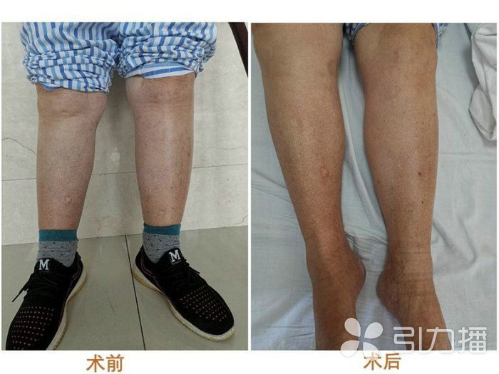 苏报集团（引力播）：两腿肿了十多年 竟因一种危及生命的罕见病.jpg