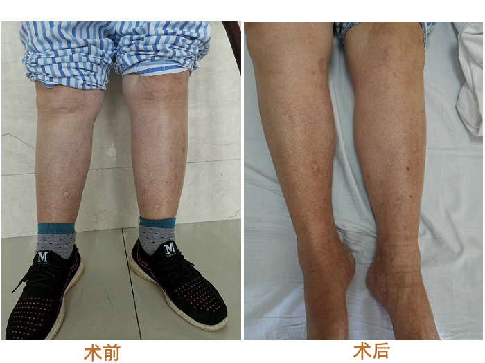 阿姨双下肢不明原因肿胀 竟是得了这种少见病 (2).jpg