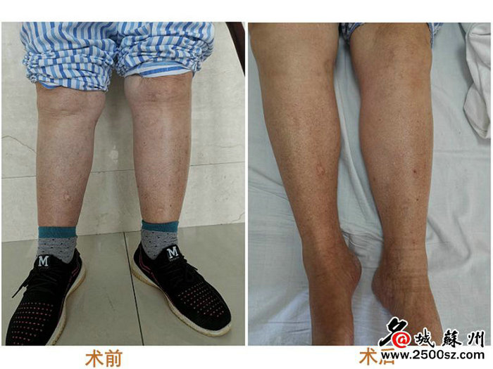 双下肢不明原因肿胀 竟是这种危及生命的罕见病 (1).jpg