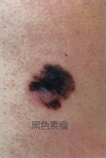 警惕！小黑痣突然变大，当心黑色素瘤.png
