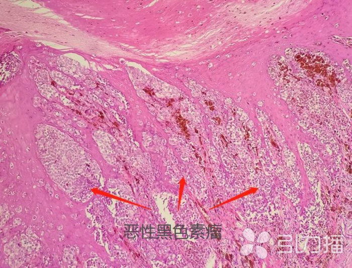 苏报集团（引力播）：警惕！小黑痣突然变大，当心皮肤癌！.jpg