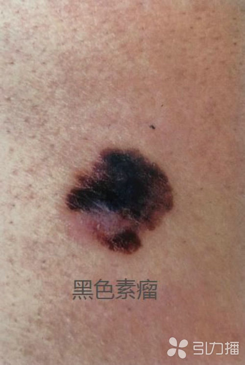 苏报集团（引力播）：警惕！小黑痣突然变大，当心皮肤癌！2.jpg