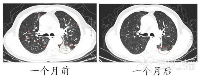 苏报集团（引力播）：大爷连咳三周确诊为肺癌 精准靶向治疗解难题.jpg