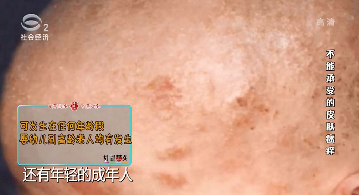 告别皮肤瘙痒！我院皮肤科专家做客《施斌聊斋》话湿疹2.png