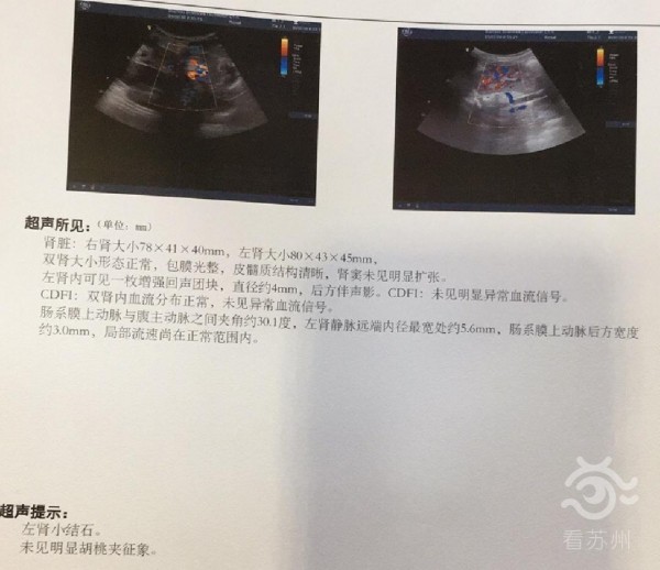 看苏州：惊！苏州5岁女孩肾上长“石头”，医生：这些习惯要改！2.jpg