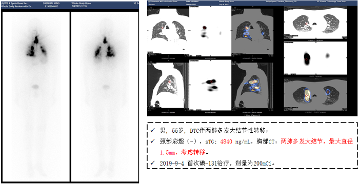  碘-131治疗助力患者对抗甲癌晚期 疗效显著 (3).png