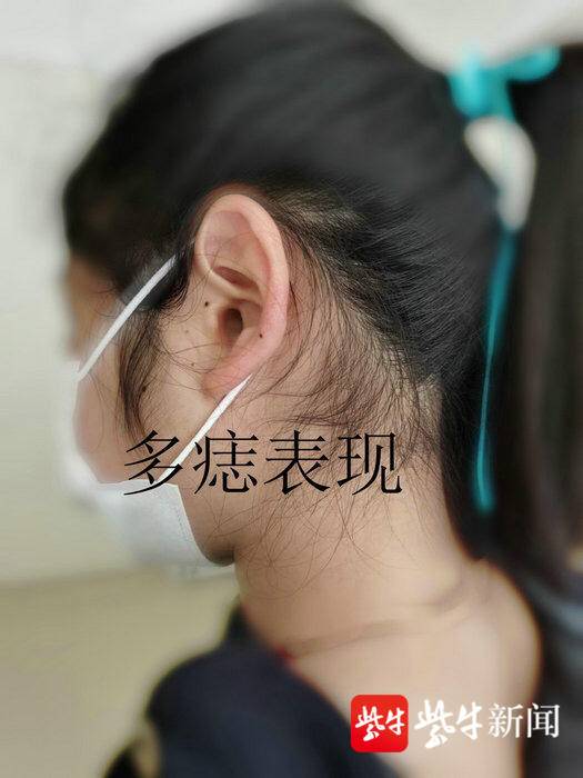扬子晚报（紫牛新闻）：花季少女个子矮小，竟是患上了这个少见病.jpg