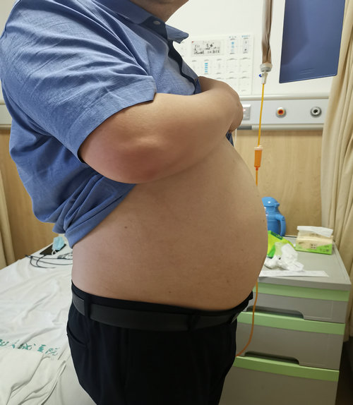 男子肥胖导致多发并发症 肥胖MDT门诊助力科学减肥.jpg