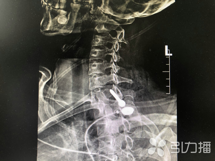 苏报集团(引力播):“飞”来横祸 苏州一女子被铁钉扎进脖子.jpg 苏报集团(引力播):“飞”来横祸 苏州一女子被铁钉扎进脖子.jpg