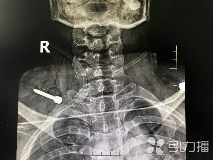 苏报集团(引力播):“飞”来横祸 苏州一女子被铁钉扎进脖子2.jpg 苏报集团(引力播):“飞”来横祸 苏州一女子被铁钉扎进脖子2.jpg