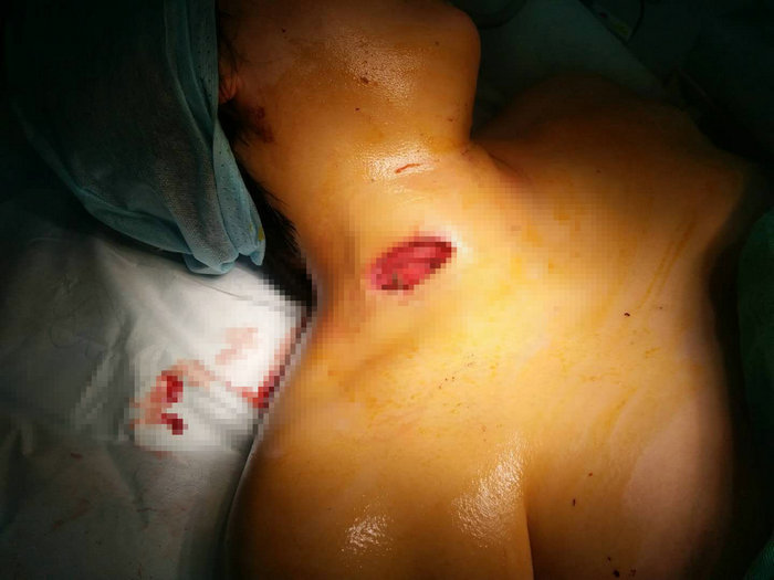 名城苏州：吓人！5厘米长的铁钉飞进女子脖子 险伤劲动脉2.jpg