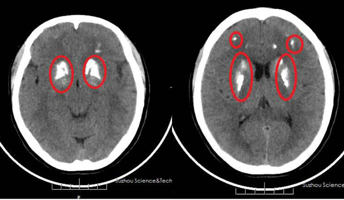 头昏脑胀,一年轻女子脑子“变硬”.jpg 头昏脑胀,一年轻女子脑子“变硬”.jpg