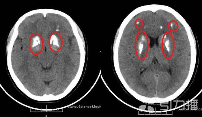 苏报集团（引力播）：女子总是头晕失眠 竟因脑子“变硬”了.jpg