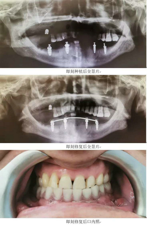 数字化助力精准种植 让种牙精准舒适2.jpg