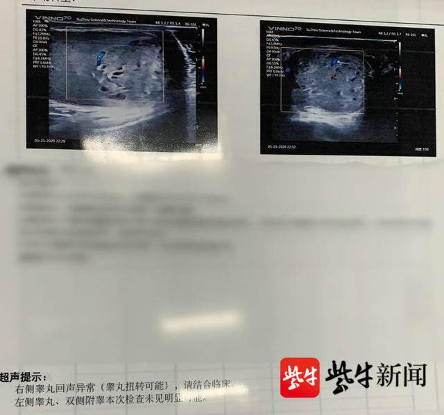 扬子晚报（紫牛新闻）：苏州一小伙睾丸扭转险切除.jpg