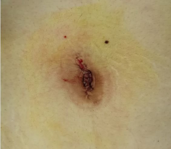 经脐单孔腹腔镜 无痕深受爱美女性青睐.jpg