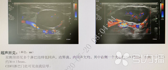 苏报集团（引力播）：苏城4岁娃高烧不退 竟是感染了“亲吻病毒”3.png