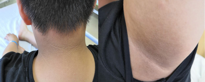 男孩肥胖两度入院 肥胖MDT联合诊治.png