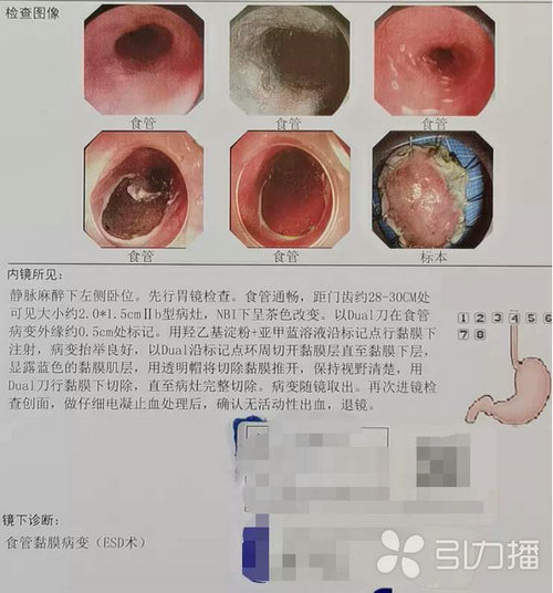 苏报集团（引力播）：胸部隐约不适，阿姨查出食管癌.jpg