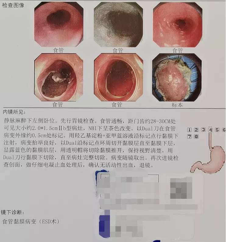 胸部不适，一阿姨查出早期食管癌！.jpg