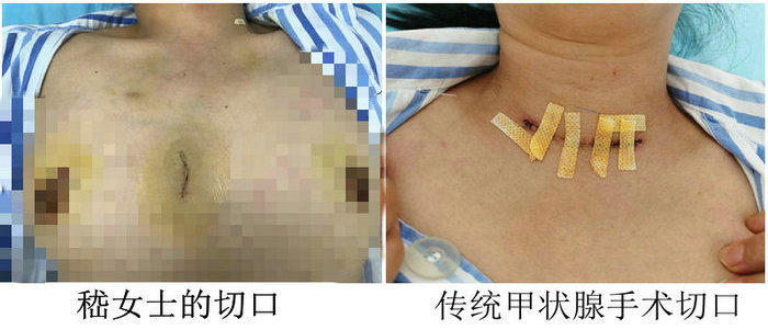 颈部完美无痕,我院成功开展腔镜甲状腺微创手术.jpg 颈部完美无痕,我院成功开展腔镜甲状腺微创手术.jpg