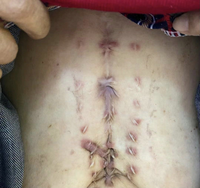 苏州阿姨慢性骨髓炎 伤口护理中心“用爱握手”超暖心.jpg