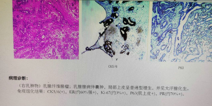 未婚女青年罹患乳腺纤维腺瘤 专家建议….jpeg