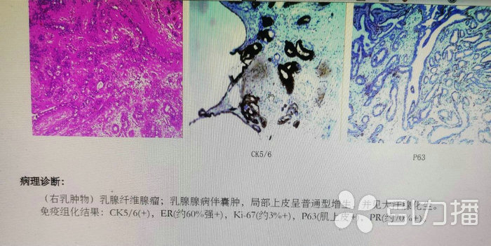 苏报集团(引力播):20岁女子乳房长瘤 专家建议加强自检.jpg 苏报集团(引力播):20岁女子乳房长瘤 专家建议加强自检.jpg