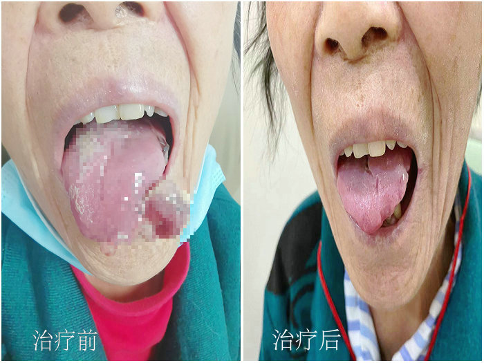 “你们真个好” 90高龄阿婆舌体肿瘤 这波服务真暖心.jpg