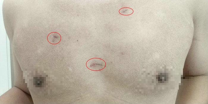 颈部无痕 我院普外二科成功开展男性腔镜甲状腺手术.jpg