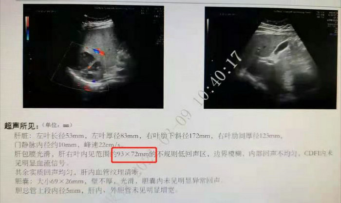 男子高热、肝区不适，竟是肝脓肿！这种病男性更高发.jpg