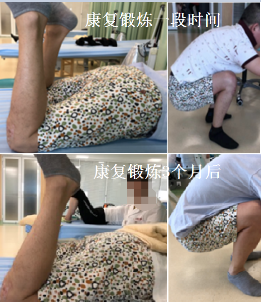 男子修养三月关节僵硬 专家提醒走出养伤误区.png