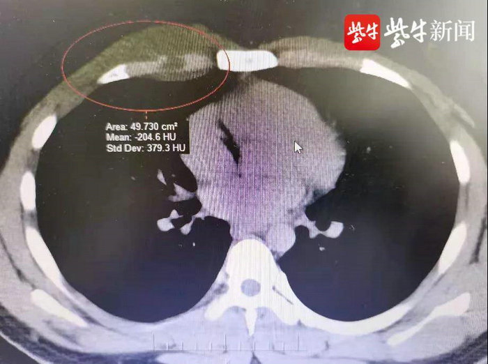 扬子晚报（紫牛新闻）：不良生活习惯导致，16岁少年被确诊胸壁肿瘤.jpg