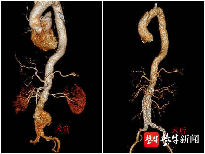 扬子晚报(紫牛新闻):中年男子突发腰痛险丢性命 医生建议出现疼痛不要强忍.jpg 扬子晚报(紫牛新闻):中年男子突发腰痛险丢性命 医生建议出现疼痛不要强忍.jpg