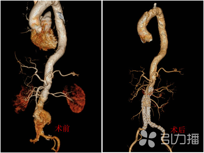 苏报集团(引力播):中年男子突发腰痛险丢性命 医生建议出现疼痛不要强忍.jpg 苏报集团(引力播):中年男子突发腰痛险丢性命 医生建议出现疼痛不要强忍.jpg